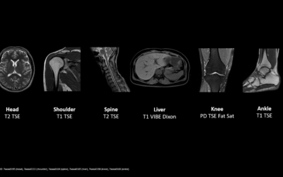Siemens Healthineers facilitates access to MRI with cost-effective whole-body scanner